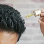 Minoxidil for Hair Growth: Pros, Cons, and Results